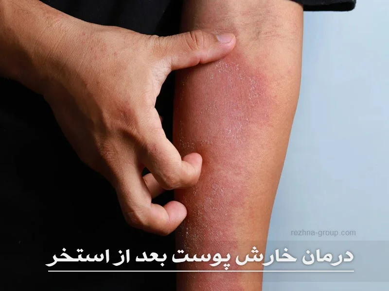 درمان خارش پوست بعد از استخر
